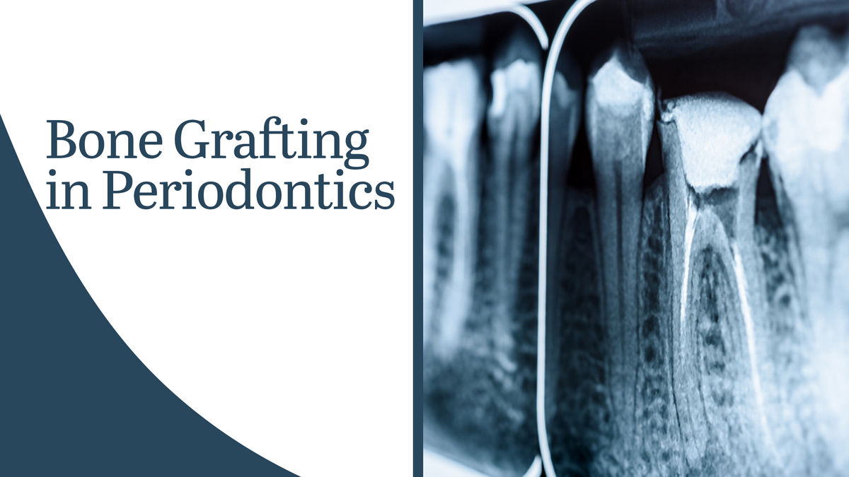 Bone Grafting in Periodontics